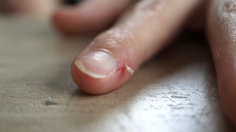 Skin peeling around the nail