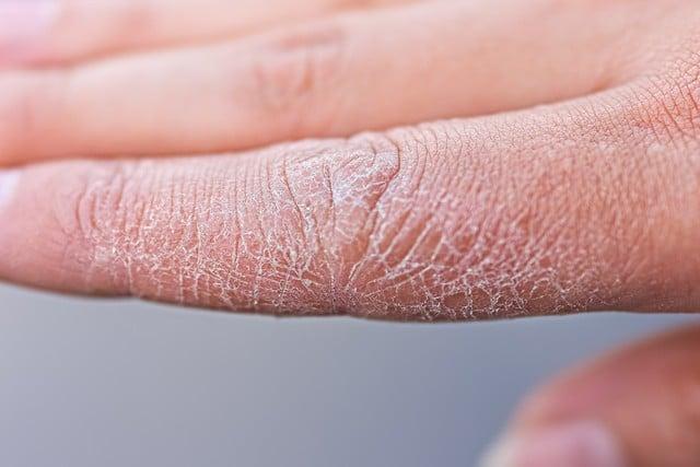 Flaky Skin