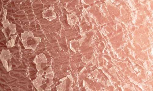 Eczema and dry skin