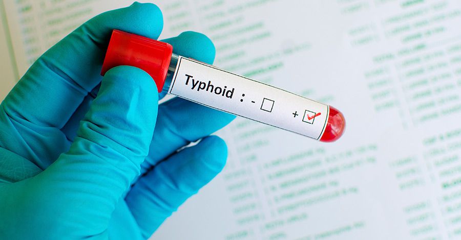 4 stages of typhoid fever: Symptoms and progression explained
