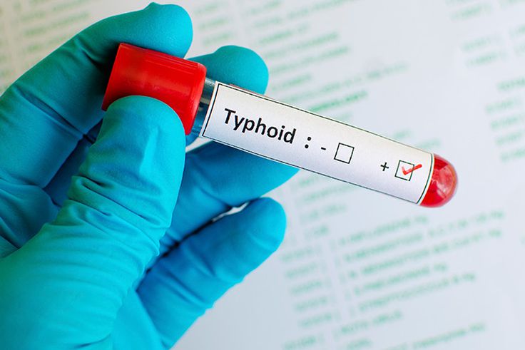 4 stages of typhoid fever: Symptoms and progression explained