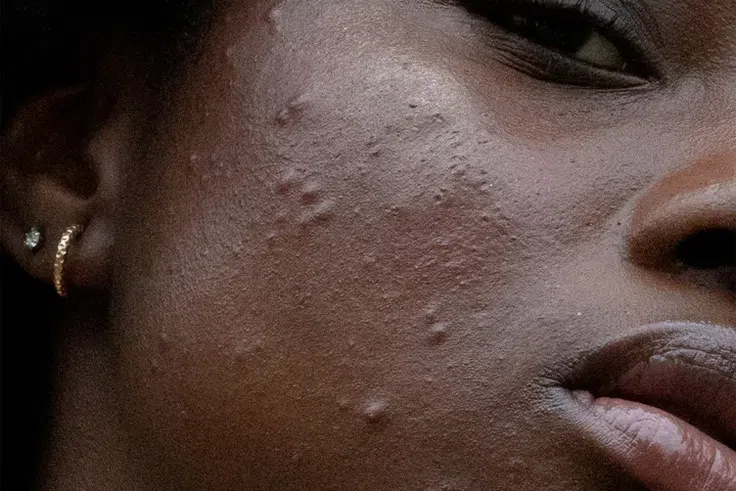 6 common foods that may be causing your acne (without you realising It)