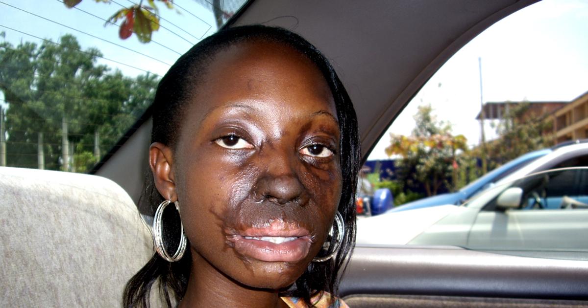 Acid Attack Survival Guide: Critical First Aid Steps and Safety Tips