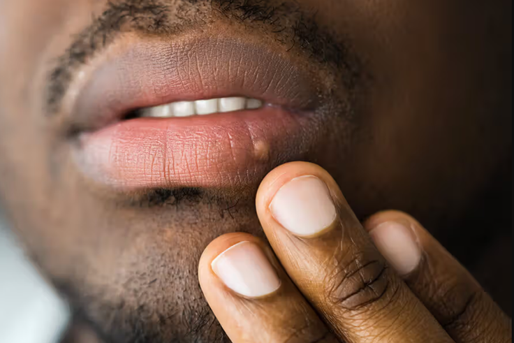 Can I get an STD from oral sex?
