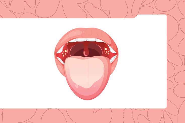 The Gross Truth About Tonsil Stones (and Why They Make Your Breath Smell)