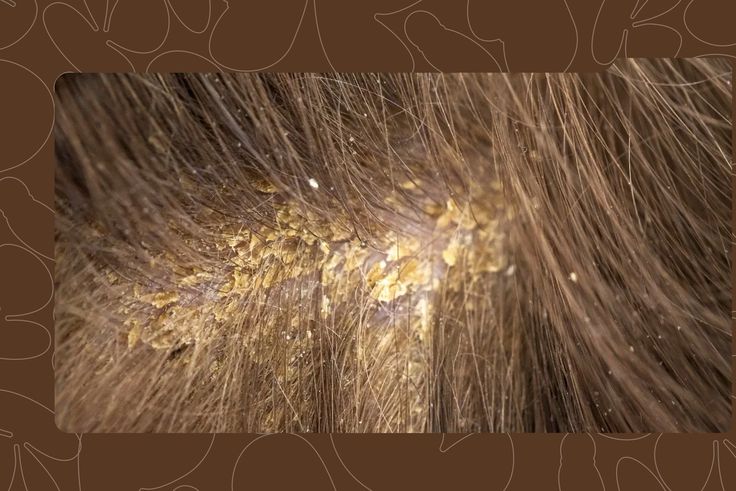 The Best Scalp Treatments for Dandruff, Dryness, and Hair Growth