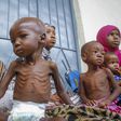Nigeria has the most malnourished children in Africa — 2nd globally