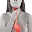 3 Natural ways to get rid of acid reflux in the throat