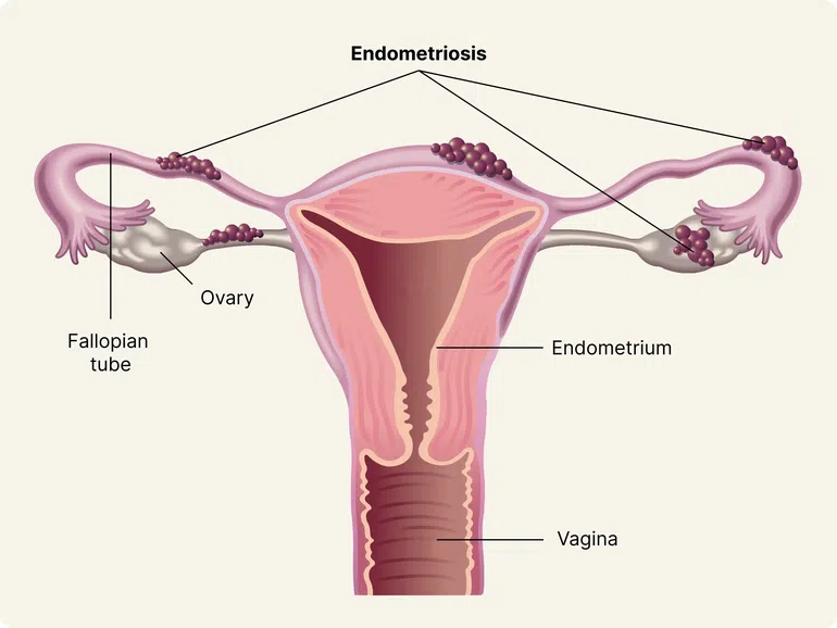 painful-period-endometriosis