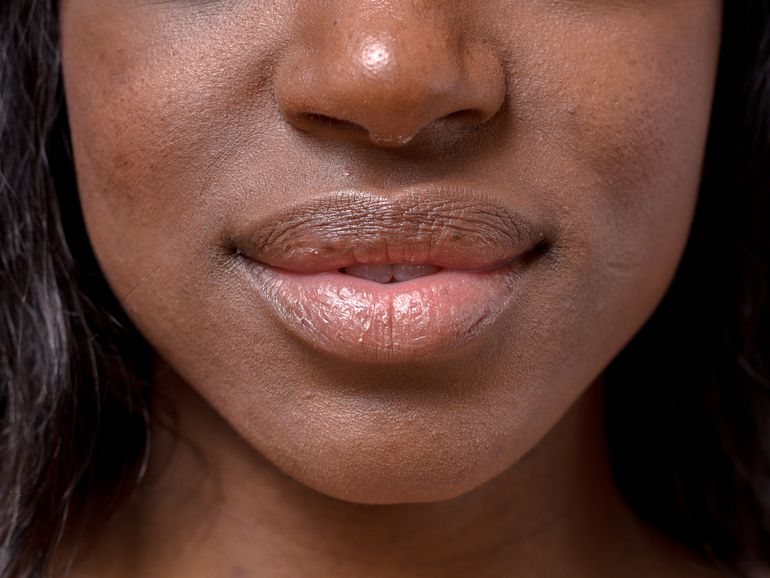 dry-cracked-skin-chapped-lips-during-harmattan