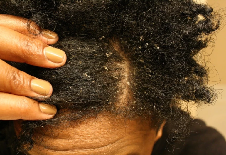 what-is-dandruff?