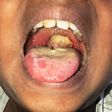 Diphtheria outbreak in Nigeria: Here's all you need to know