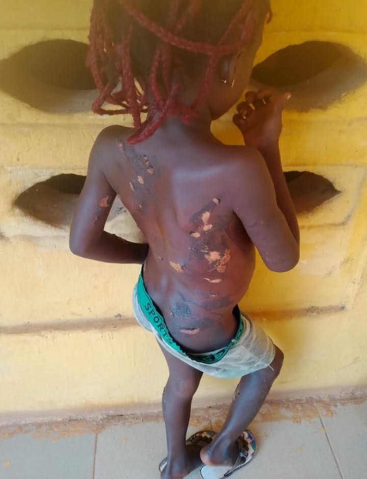 Seven-year-old Oluebube Ofoma was rescued in Anambra after she was allegedly subjected to severe physical abuse.