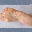 Safe and Effective Ways to Remove Callus From Your Feet