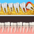 Teething isn’t just for babies: why wisdom teeth can cause trouble in your twenties