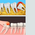 Teething isn’t just for babies: why wisdom teeth can cause trouble in your twenties