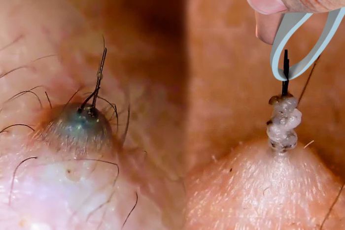 How to Get Rid of Ingrown Hair: Simple, Safe, and Effective Tips That Work