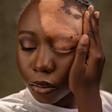 Video: ‘He said he wasn't feeling the vibe again’ — Nigerian lady says boyfriend dumped her after vitiligo diagnosis