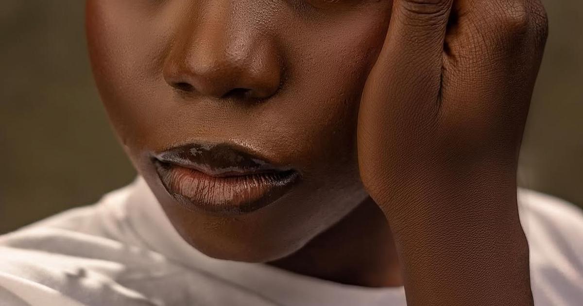 Nigerian woman says boyfriend dumped her after vitiligo diagnosis