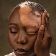 Video: ‘He said he wasn't feeling the vibe again’ — Nigerian lady says boyfriend dumped her after vitiligo diagnosis