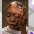 Video: ‘He said he wasn't feeling the vibe again’ — Nigerian lady says boyfriend dumped her after vitiligo diagnosis