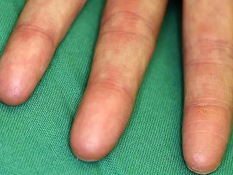 adermatoglyphia, the genetic disorder of people born without fingerprints.