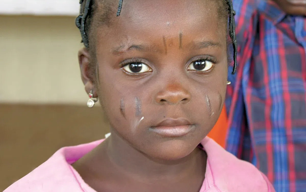 Silent but dangerous - what you need to know about Buruli Ulcer killing Adamawa residents