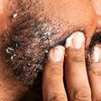 What Causes Beard Dandruff and How to Get Rid of It for Good