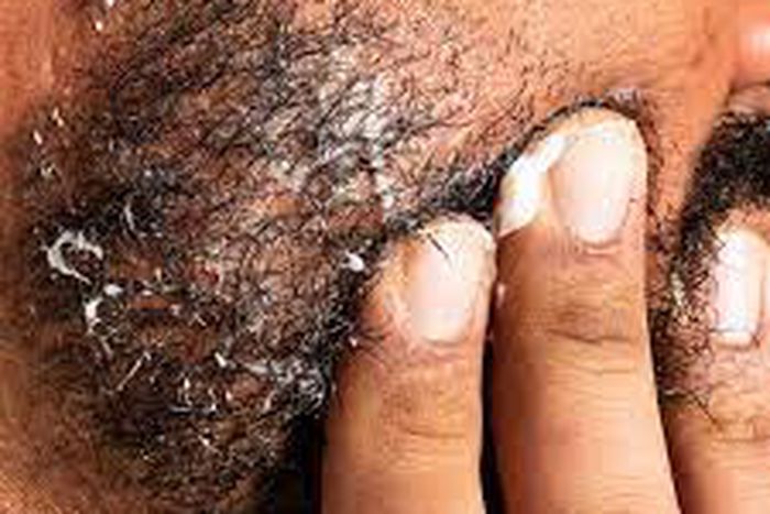 What Causes Beard Dandruff and How to Get Rid of It for Good