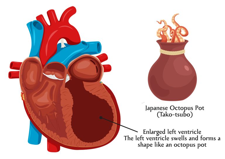 broken-heart-syndrome