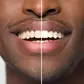 5 foods that can naturally whiten your teeth