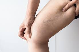 3 Natural remedies to get rid of web veins