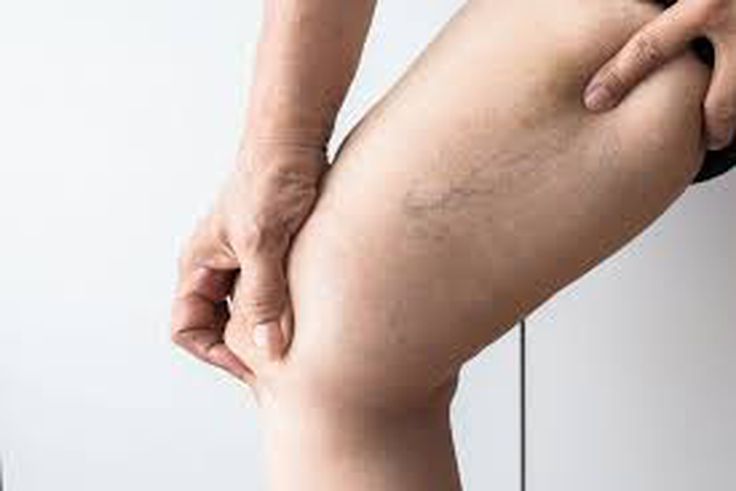 3 Natural remedies to get rid of web veins
