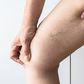 3 Natural remedies to get rid of web veins