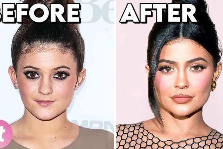 Before & After: 5 celebs whose plastic surgery transformed them completely