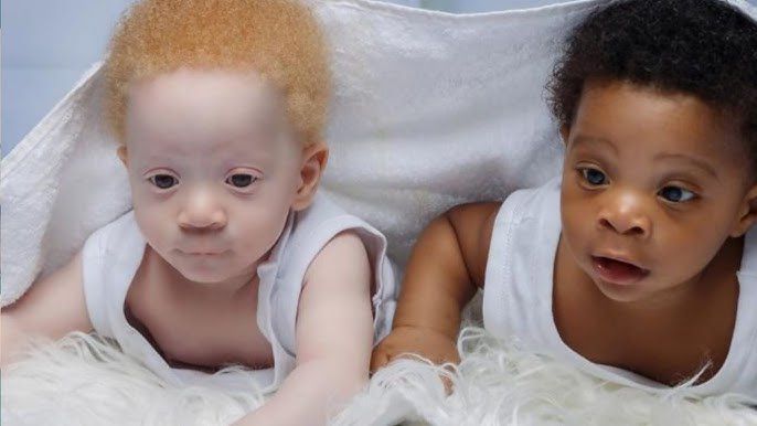 Striking physical differences in fraternal twins often spark questions about heteropaternal superfecundation