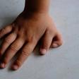 Why some people are born with 6 fingers