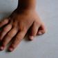 Why some people are born with 6 fingers