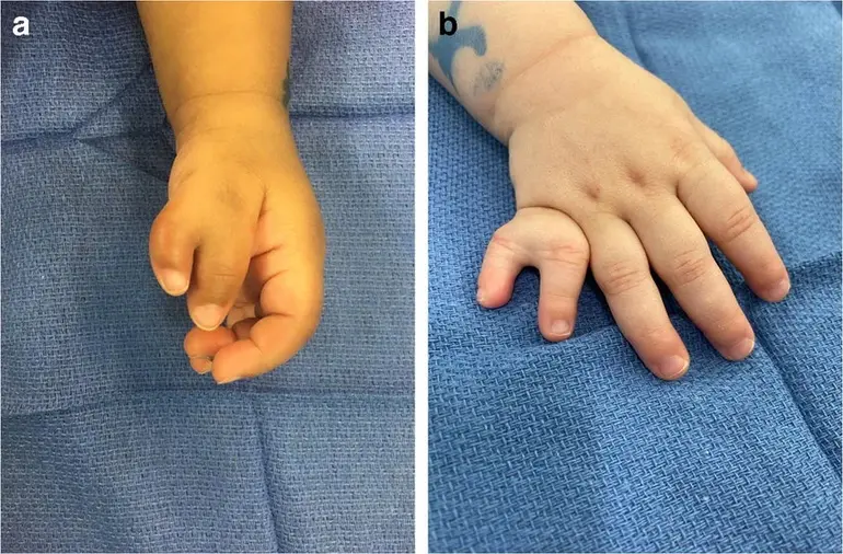 Forms of polydactyly. SOURCE: RESEARCHGATE