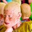 5 harmful myths about albinos you must STOP believing