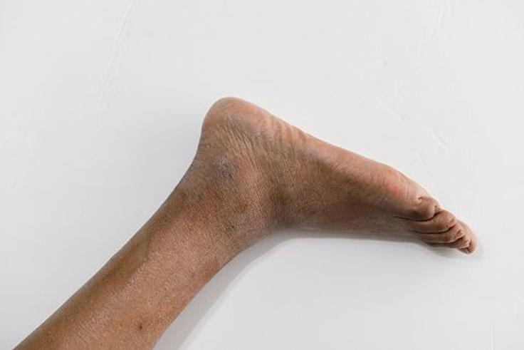 How to prevent white, cracked feet during harmattan