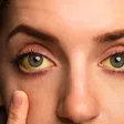 Yeux jaunes : un symptôme à prendre au sérieux, mais pas toujours synonyme de cancer
