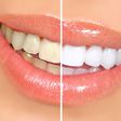 Dentifrices blanchissants : solution miracle ou simple illusion de blancheur ?