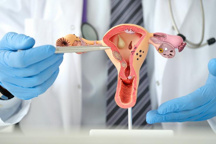 Cancer de l’ovaire : Un simple test va-t-il sauver des vies ?