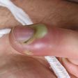 Ces 3 gestes simples font disparaître un panaris en 2 à 3 jours !