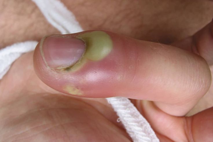 Ces 3 gestes simples font disparaître un panaris en 2 à 3 jours !