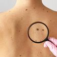 Comment reconnaître un cancer de la peau ?