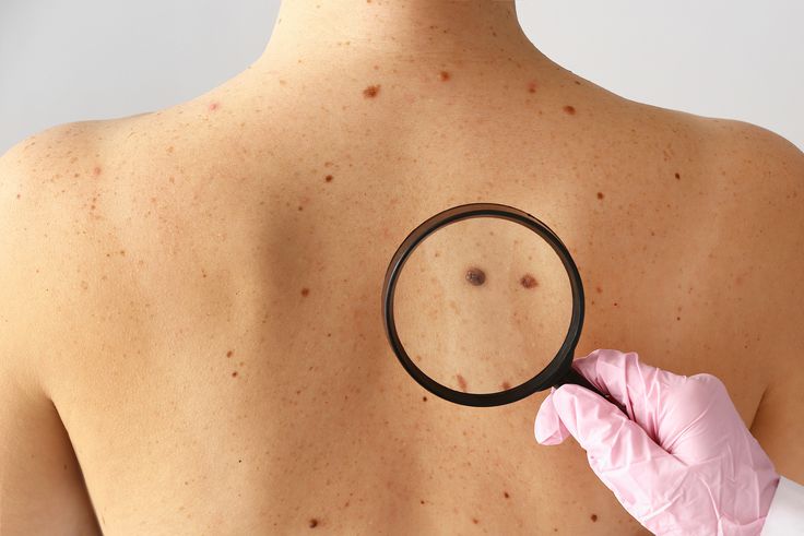 Comment reconnaître un cancer de la peau ?