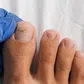 Vos ongles de pieds pourraient être un moyen de dépister précocement le cancer