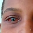 Une épidémie de conjonctivite explose à 48 h de la rentrée scolaire